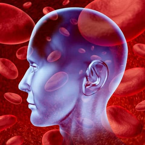 Impaired Blood-Brain Barrier After Stroke May Lead to Chronic Deficits