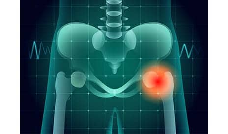 CT Study Sees Association Between Core Muscle Strength and Hip Fracture Survival