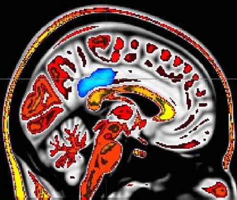 MRI Research Suggests Chronic Pain Relief Possible Via Mindfulness