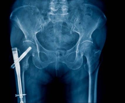 Hip Fracture Surgery is Risky, So Choose Patients Carefully, Researchers Note