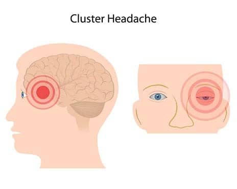 gammaCore Cluster Headache Device Receives FDA Nod