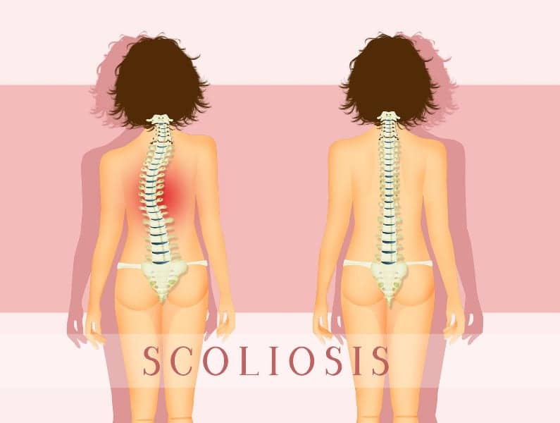 Study Evaluating 3dMD Technology for Scoliosis is Enrolling Participants