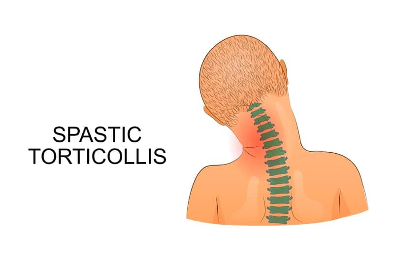 The Benefits of Physical Therapy for Torticollis in Children