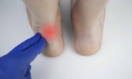 Physical Therapy May be as Good as Surgery for Achilles Tendon Rupture